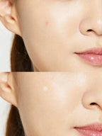 COSRX Pimple Patch – Fast Acne Treatment (24 Patches)